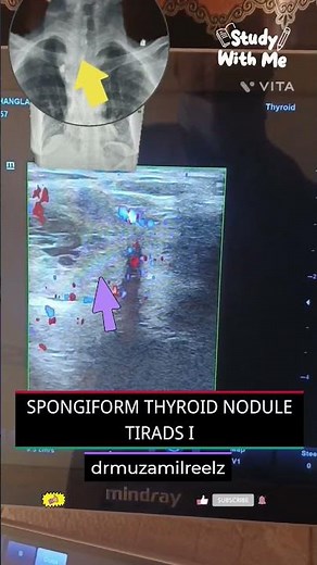 Case 116: TIRADS I Spongifrom nodule in thyroid. #tirads #thyroid #ultrasound #benign #ent surgeon