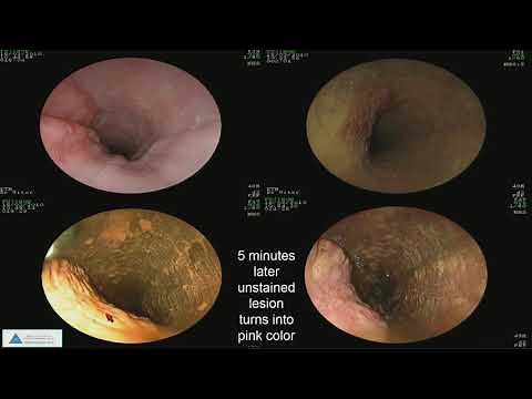 Early Detection of Esophageal Cancer and Barrett’s Esophagus: Recent Advances