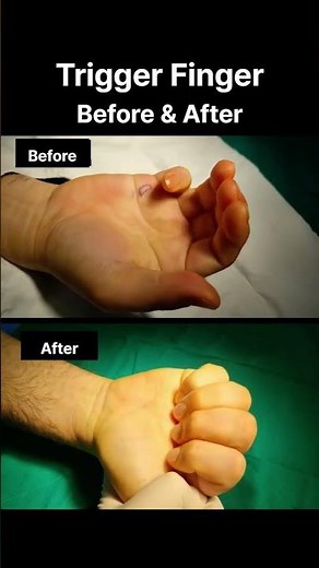 [#shorts ] Why Your Right Little Finger Won't Straighten (And The Solution) #triggerfinger