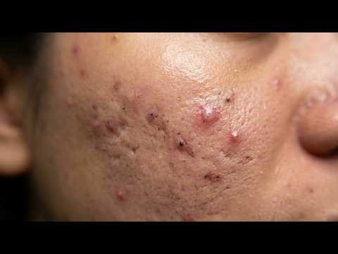 Loan Nguyen Acne Treatment 013x