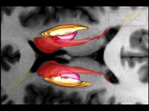 3D Brain from MRI 5 Lentiform nucleus and internal capsule