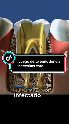 Perno dental posterior a endodoncia: ¿Qué necesitas?