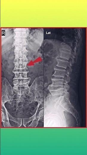 Lumbar Spondylosis X-ray LS Spine // X-ray Back Pain #shorts