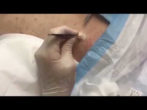 Biggest Zit on Planet Earth!