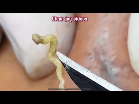 Big Cystic Acne Blackheads ExtractionBlackheads & Milia, Whiteheads Removal Pimple Popping
