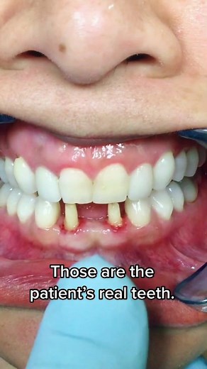 Replacing the lower front teeth with a #dentalbridge #teeth #dentist #dentalprocedure #smile #newsmile #dentalcrowns