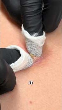 Blackheads on the back | Extractions! TW : Jessi The Esti #extractions #blackheads #esthetician