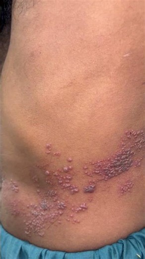 What is Shingles or Herpes Zoster Infection
