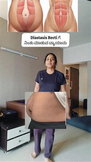 Diastasis Recti standing exercises #drdivyat #diastasisrecti #diastasisrectirecovery #homeexercises