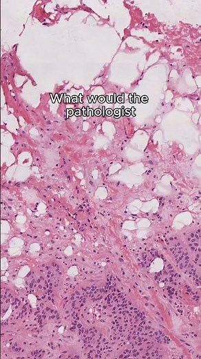 What does breast cancer look like and why? #histology #pathology #breastcancer #cancer #diagnosis