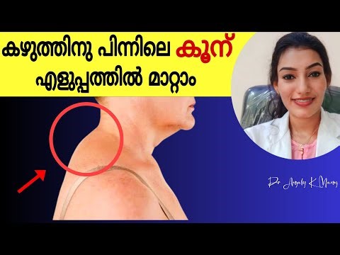 കഴുത്തിലെ കൂന് വീട്ടിൽ ഇരുന്നുകൊണ്ട് കുറക്കാം |Tips for neck hump| Dr Anjaly K Manoj