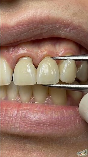 Tooth Gap Closed with Dental Bridge 🦷 3D Dental Animation #dental#teeth#dentalbridge#toothgap
