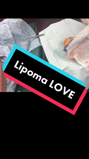 I have the best patients EVER. Lipoma removal under local anesthesia using tumescent numbing #drpimplepopper #SLMDskincare
