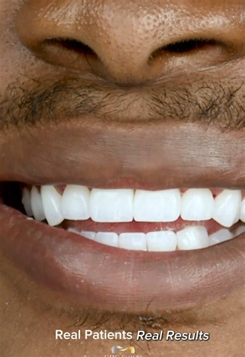 Porcelain Veneers Summer Sale — $4,999 Limited Offer