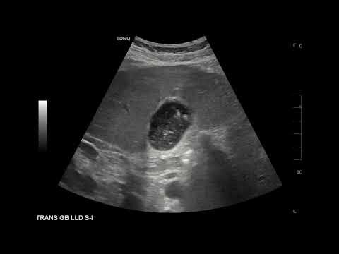 Ultrasound Case: Biliary Sludge with Comet Tail Artifact