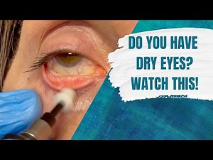 Do you have dry eyes? Watch this!