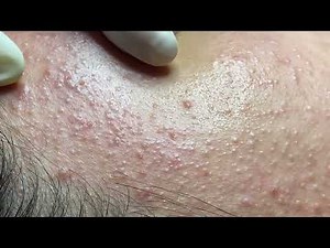 Acne treatment for Spa Linh Mun 2024 #148