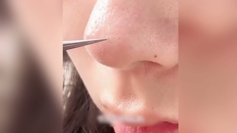 2025 Medical Grade Blackhead Extraction Tool Kit, Professional Facial Blackhead Remover Tweezers, Grade Extractor Tool for Removal Black Heads, Whiteheads, Pimples, Blemishes and Pimples