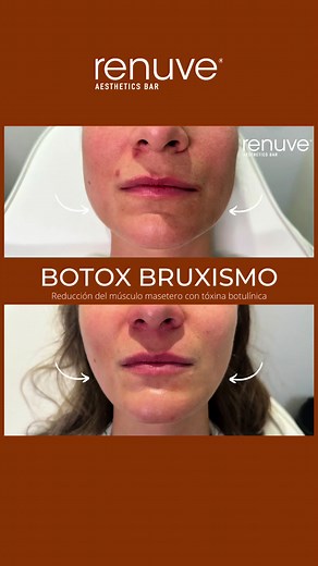 BOTOX PARA TRATAR TU PROBLEMA DE BRUXISMO 💉🤍 Aplicar botox en los músculos maseteros tiene un beneficio tanto terapéutico como estético ✨ Como tratamiento terapéutico ayuda a tratar el bruxismo, que es el trastorno de apretar mucho la mandíbula y los dientes inconscientemente ya sea despierto o dormido, el botox ayuda a relajar este músculo y alivia la tensión y el dolor que este causa. Estéticamente da una apariencia de menos cachete y un rostro más afilado y delgado 💉🤍 Puedes aplicarlo a p