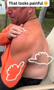 2.2K views · 14 reactions | #poppingpimples #blackheadsextraction #whiteheadsextraction #zit #extraction #oddlysatisfying #acne #drpimplepopper #doctor (113) | Pimple Popper | Facebook