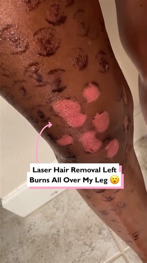 Laser hair removal left me with first and second degree burns 😳 | Four Nine