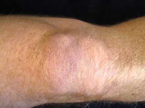 Knee Osteoarthritis Exercises - Static Quads