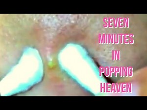 Super Acne Popping Compilation | 7 Popaholic Minutes of the Best Pimples & Zits On The Web
