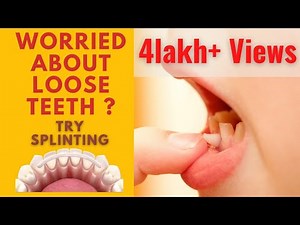 Treatment of Loose Teeth- Splinting |how to fix loose teeth part 2 | hilne wale daant ko fix kare