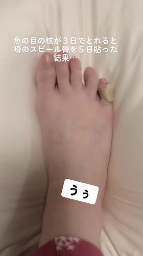 魚の目ケアとスピール膏の効果