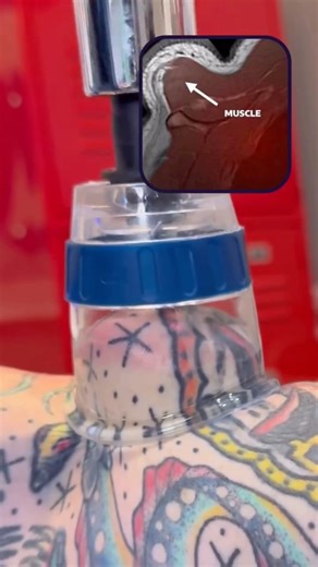 Dr. Kyle Ross on Instagram: "🏆 Cupping therapy uses suction to lift and decompress layers of fascia and muscle, helping improve blood flow, reduce stiffness, and ease deep muscle tension. Great for recovery and stress relief—sometimes you need to pull to release. 📷 MRI @cuptherapy #CuppingTherapy #MyofascialRelease #ChicagoChiropractic #ChiropracticCare #drkyleross"