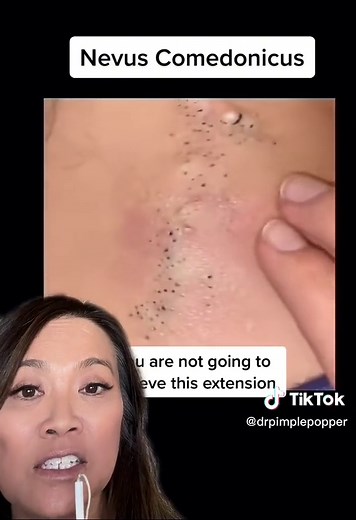 #duet with @sairashairyworld #extractions its good luck if you know someone with a nevus comedonicus #ASMR #drpimplepopper #SLMDskincare
