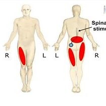 Video: Dorsal Column Steerability with Dual Parallel Leads using Dedicated Power Sources:  A Computational Model