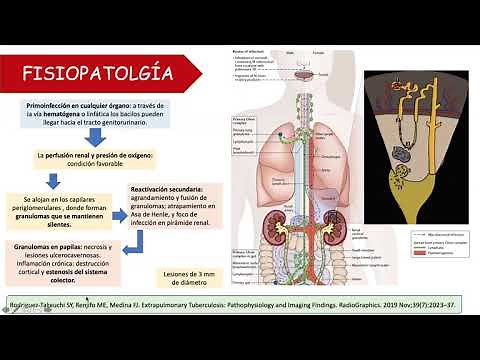 Tuberculosis renal – SOCIEM UCV PIURA