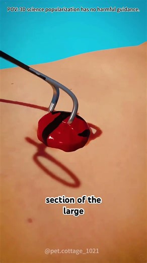 How a colostomy bag works? #lofi #facts #doctor #3danimation #science