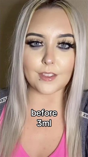 before and after 3ml of lip filler #lipfillers #lipfiller #lipinjections #beforeandafterlipfiller