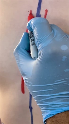 Breast Augmentation with Implants