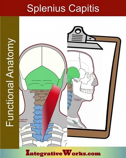 Headache at the top of the head - Splenius capitis trigger point