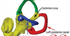 [臨床思考] 良性陣發性位置性眩暈的評估 Assessment of BPPV
