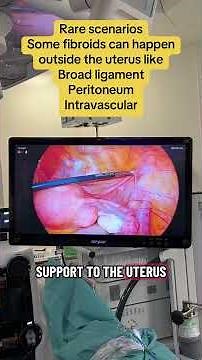 Multiple Fibroid Removal Surgery Explained #womenshealth #shorts