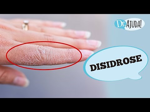 DYSHIDROSIS (BLISTERS ON HANDS AND/OR FEET): CAUSES, DIAGNOSIS AND TREATMENT