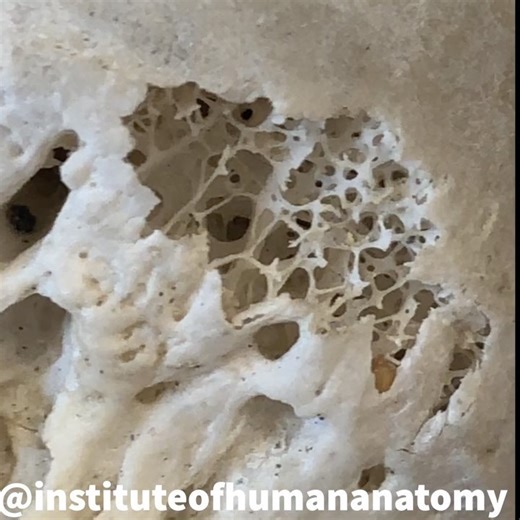 Institute of Human Anatomy on Instagram: "SPONGY BONE is the deep, more porous region of bone tissue. Spongy bone is also known as trabecular bone (trabeculae = little beams) due to the tiny beams of bone tissue that make up the “spongy” architecture. . . Spongy bone is always covered with a layer of compact bone for added protection. The little beams, trabeculae, of spongy bone may appear unorganized, but make no mistake the trabeculae are organized in the lines of stress, which helps bone resi