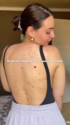 NATURAL UKRAINIAN COSMETICS 🌱 | Якщо тобі набридло, коли прищі на спині або сідницях з’являються без запрошення, тоді цей набір — саме те, що потрібно! 👏 Hillary... | Instagram