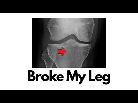 I Broke My Leg — Here's What Happened and How I'm Rebuilding