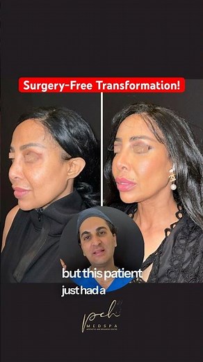 I Got a Non-Surgical Facelift with ENDOLIFT Laser - Here’s What Happened | PCH MedSpa