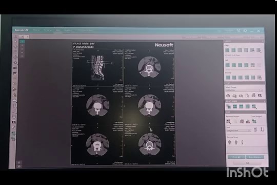 Filminig du rachis lombaire/Neusoft