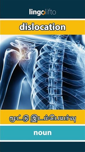 🇬🇧🇮🇳 dislocation - மூட்டு இடம்பெயர்வு : learn English : ஆங்கிலம் கற்போம்