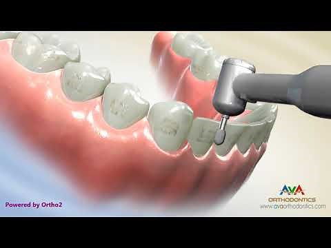 Removing Orthodontic Braces or Debond