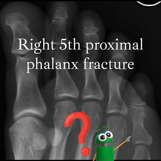 5th proximal phalanx fracture