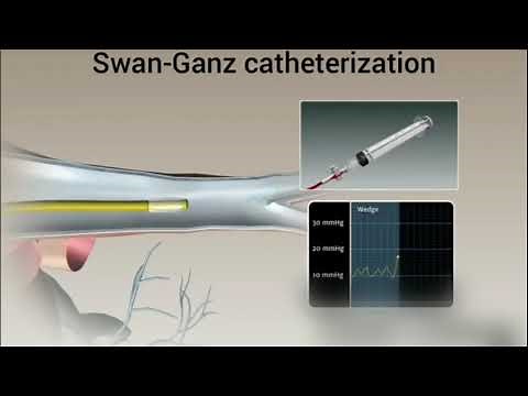 Swan-Ganz catheter