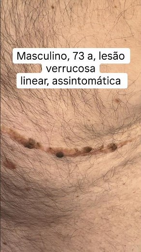 Queratose seborreica: parece verruga, mas não é. #queratoseseborreica #verruga